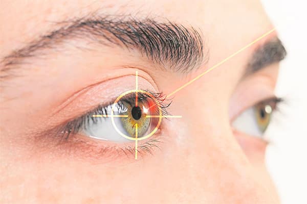 laser lasik vs smile operation chirurgie refractive oeil paris dr camille rambaud chirurgien ophtalmologue paris